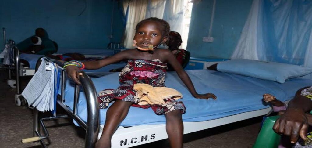 Noma surgery in Nigeria helps children recover from facial disease