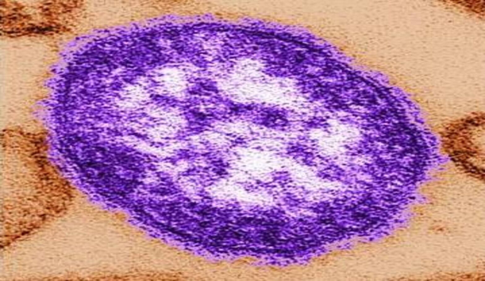 Pennsylvania measles outbreak raises concern after woman dies from complications